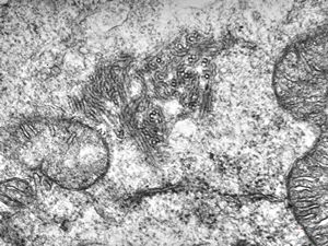 M,18y. | blood - tubular inclusions in lymphocytes M,18y. | blood - tubular inclusions in lymphocytes